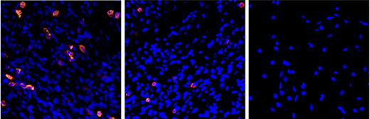 צילום של רקמת עכבר (תאי הרקמה בכחול) באמצעות מיקרוסקופ אור: כאשר הגידול מושתל בגב העכבר (משמאל), תאים אימוניים (בוורוד) חודרים אליו ומחסלים את הסרטן; כאשר הגידול מושתל למוח העכבר (באמצע), חודרים אליו מעט מאוד תאים אימוניים, והגידול ממשיך לצמוח; רקמת מוח רגילה (מימין) אינה חדירה כלל לתאים אימוניים