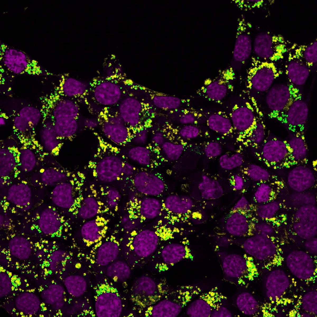Breast cancer tissue after treatment with sildenafil. Cholesterol (green) is trapped within tiny sac-like organelles called lysosomes, making it unavailable to the cancer cells. Cell nuclei are shown in purple