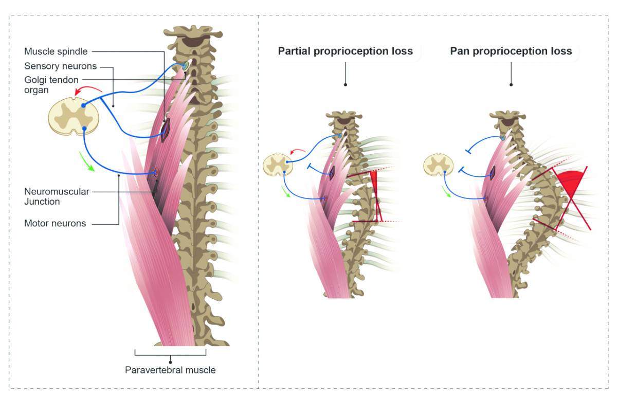 מנח תקין של עמוד השדרה (משמאל) והתפתחות עקמת בעקבות היעדר מלא (מימין) או חלקי (במרכז) של קולטני חישה מכניים 
