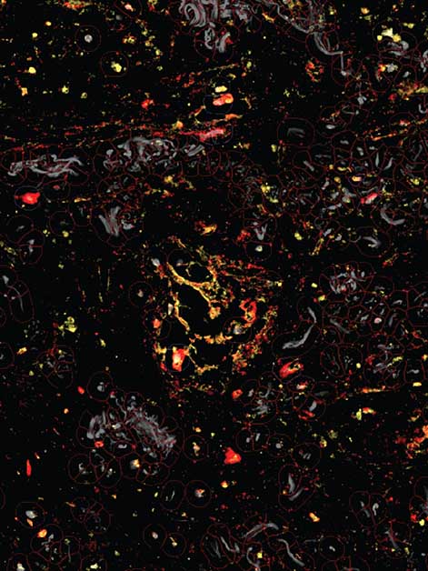 רקמת סרטן ריאות אנושית תחת המיקרוסקופ. בסביבת המקרופאגים הסייענים (באדום) נמצאים גם אנזימים (בצהוב) שמכניסים לפעולה את החלק המעורר בנוגדנים שפותחו. פעולה ממוקדת זו מונעת פגיעה ברקמות בריאות