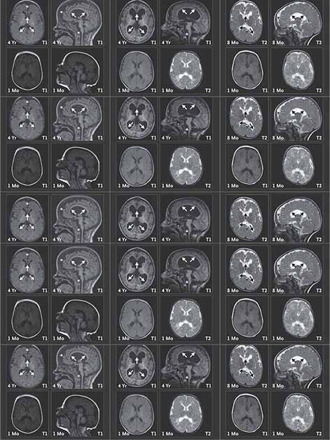 ממצאי דימות תהודה מגנטית (MRI) של המוח בשלושה ילדים עם עותק חסר של צ'ייסר. הסריקות שנעשו בגיל 8 חודשים או 4 שנים (שורה עליונה) מעידות על שינויים מבניים במוח: אזורים קדמיים שהצטמקו, גזע מוח קטן יחסית (מסומן בכוכביות), והתפתחות לא תקינה של מעטפת העצבים (מיאלין) באזורים עמוקים במוח (מסומנת בחיצים). שינויים אלה כמעט שלא נראו בסריקות מגיל חודש (שורה תחתונה)