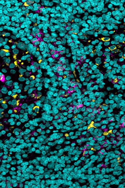 תאים של המערכת החיסונית (בצהוב) המבטאים על פניהם את "דוושת הבלמים" (הקולטן FcgIIb, בסגול) בדגימת רקמה של סוג נדיר ואלים של סרטן עור; בכחול – גרעיני תאים