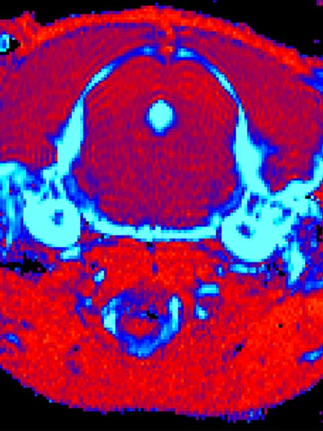 MRI brain scans of mice with Gaucher disease Type III. The scan of a mouse that received the new treatment (left) shows a significant reduction in tissue inflammation (blue) compared to an untreated mouse (right)