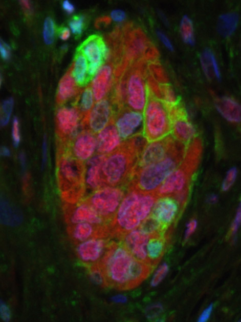 A tumor sample from a human patient with the most common type of lung cancer (adenocarcinoma). Senescent cells are highlighted by their expression of the p16 (red) and the PD-L1 (green) proteins. Cell nuclei are in blue