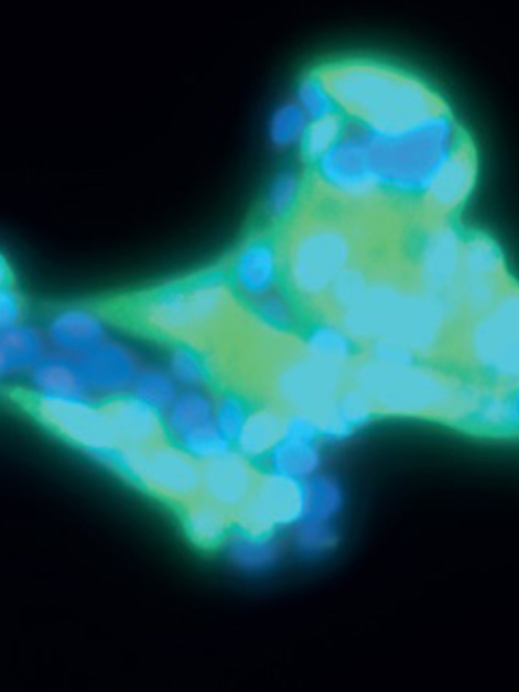 Microscopic image of cultured human lung cells infected with SARS-CoV-2