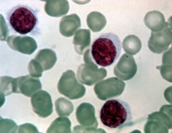 Leukemia cells. Image: Wikimedia commons, NIH