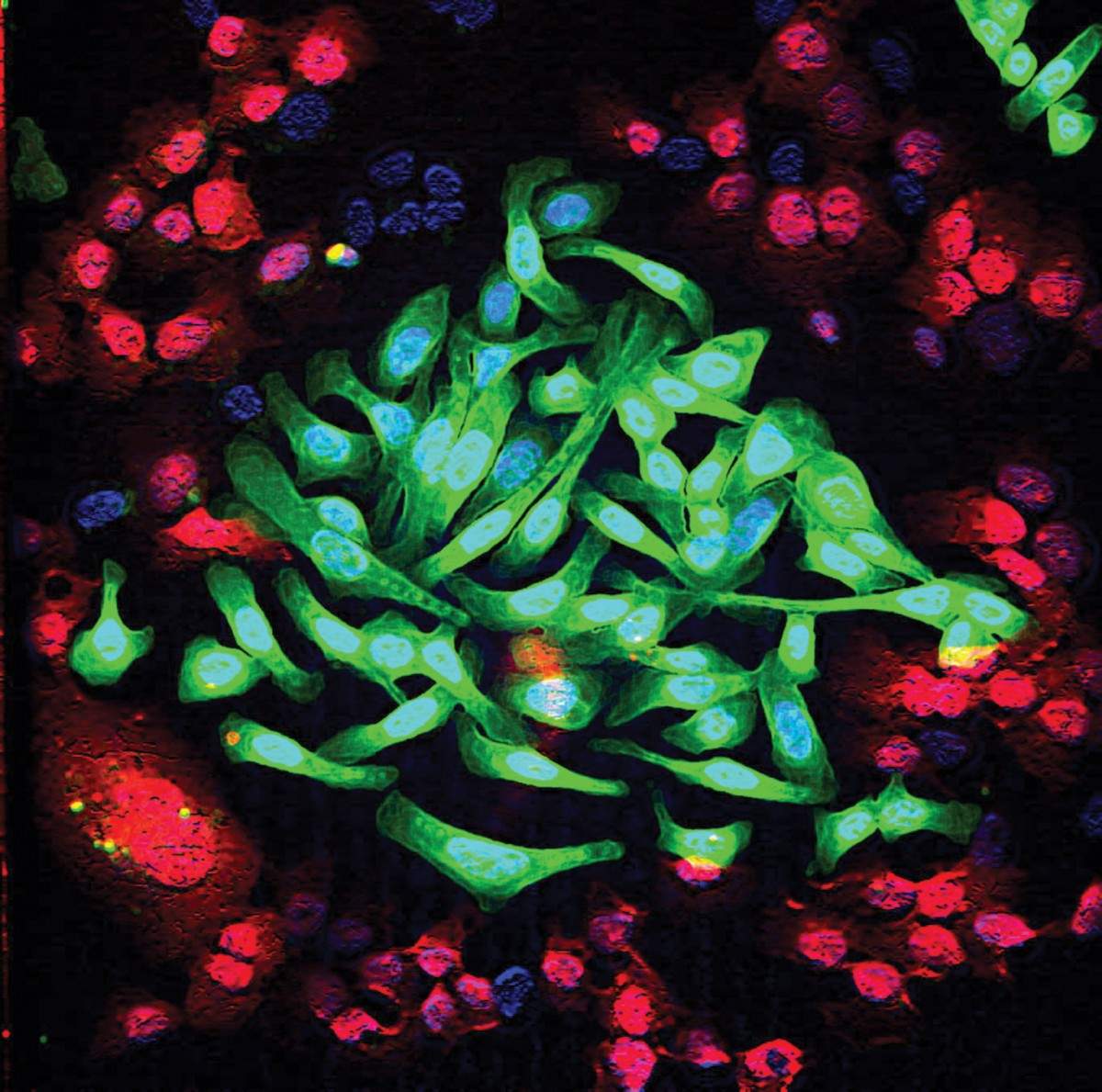 תאי סרטן ריאות (בירוק) מעורבים בתרבית עם תאי ריאות רגילים (באדום). הטיפול המשולב, באמצעות שלושה נוגדנים, מחליש מאוד את יכולת ההישרדות של תאי הגידול, אך אינו משפיע על התאים הרגילים. צילום מעובד ממיקרוסקופ קונפוקלי: מייקול מנציני ממעבדתו של פרופ' יוסי ירדן
