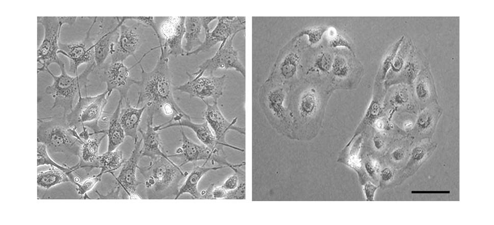 כאשר מורידים את רמת ה-PYK2 באמצעות הנדסה גנטית, חוזרים תאי סרטן שד גרורתיים (משמאל) למצב בלתי-פולשני (מימין). במצב זה הם באים במגע זה עם זה ומקבלים צורה של תאי רקמה בריאים
