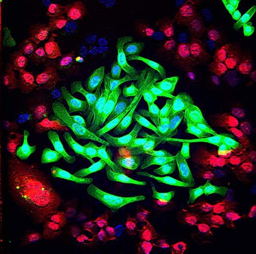 תאי סרטן ריאות (בירוק) מעורבים בתרבית עם תאי ריאות רגילים (באדום). הטיפול המשולב בשלושה נוגדנים מחליש מאוד את יכולת ההישרדות של תאי הגידול, ואינו משפיע על התאים הרגילים. צילום מעובד ממיקרוסקופ קונפוקלי: מייקול מנציני ממעבדתו של פרופ' יוסי ירדן