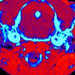 סריקת MRI מוח בעכבר עם מחלת גושה סוג 3 שקיבל טיפול גנטי (מימין) ובעכבר חולה שלא טופל (משמאל). הסריקה חושפת הפחתה משמעותית ברמת הדלקתיות ברקמה (מסומנת בתכלת) בעכבר שטופל 