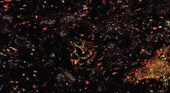 רקמת סרטן ריאות אנושית תחת המיקרוסקופ. בסביבת המקרופאגים הסייענים (באדום) נמצאים גם אנזימים (בצהוב) שמכניסים לפעולה את החלק המעורר בנוגדנים שפותחו. פעולה ממוקדת זו מונעת פגיעה ברקמות בריאות