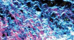 תמונת מיקרוסקופ של הסיבים שמייצרים הפיברובלסטים בסביבת הגידול הסרטני. למעלה: סיבים מסודרים בדגימות שנלקחו מחולי סרטן לבלב בעלי גן BRCA תקין, למטה: סיבים מסועפים בדגימות מחולים הנושאים מוטציה בגן