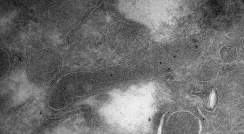 תא חיידק (מאורך, במרכז התמונה) בתוך תא של סרטן מוח מסוג גליובלסטומה, כפי שנראה מבעד למיקרוסקופ אלקטרונים. הנקודות השחורות בתא החיידק – נוגדנים מהונדסים שנושאים חלקיקי זהב ונקשרים באופן ממוקד לרכיב הקיים רק במעטפת התא של חיידקים ולא בתאים אנושיים