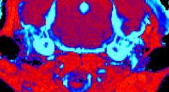 סריקת MRI מוח בעכבר עם מחלת גושה סוג 3 שקיבל טיפול גנטי (מימין) ובעכבר חולה שלא טופל (משמאל). הסריקה חושפת הפחתה משמעותית ברמת הדלקתיות ברקמה (מסומנת בתכלת) בעכבר שטופל 