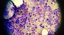 תאים עמידים לתרופות של מיאלומה נפוצה (סגול-כחול) תחת מיקרוסקופ