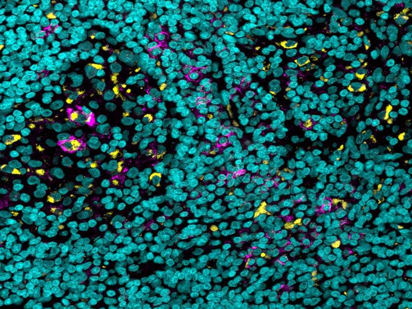 תאים של המערכת החיסונית (בצהוב) המבטאים על פניהם את "דוושת הבלמים" (הקולטן FcgIIb, בסגול) בדגימת רקמה של סוג נדיר ואלים של סרטן עור; בכחול – גרעיני תאים