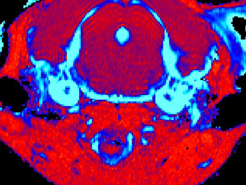 סריקת MRI מוח בעכבר עם מחלת גושה סוג 3 שקיבל טיפול גנטי (מימין) ובעכבר חולה שלא טופל (משמאל). הסריקה חושפת הפחתה משמעותית ברמת הדלקתיות ברקמה (מסומנת בתכלת) בעכבר שטופל 