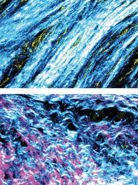תמונת מיקרוסקופ של הסיבים שמייצרים הפיברובלסטים בסביבת הגידול הסרטני. למעלה: סיבים מסודרים בדגימות שנלקחו מחולי סרטן לבלב בעלי גן BRCA תקין, למטה: סיבים מסועפים בדגימות מחולים הנושאים מוטציה בגן