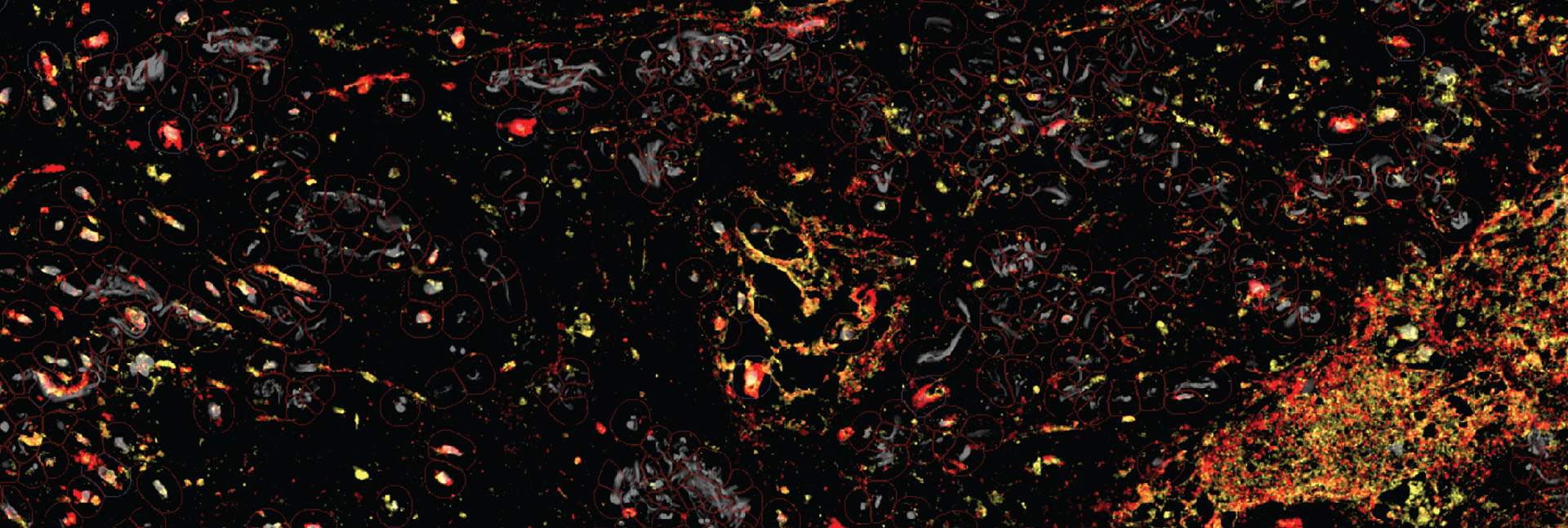 רקמת סרטן ריאות אנושית תחת המיקרוסקופ. בסביבת המקרופאגים הסייענים (באדום) נמצאים גם אנזימים (בצהוב) שמכניסים לפעולה את החלק המעורר בנוגדנים שפותחו. פעולה ממוקדת זו מונעת פגיעה ברקמות בריאות