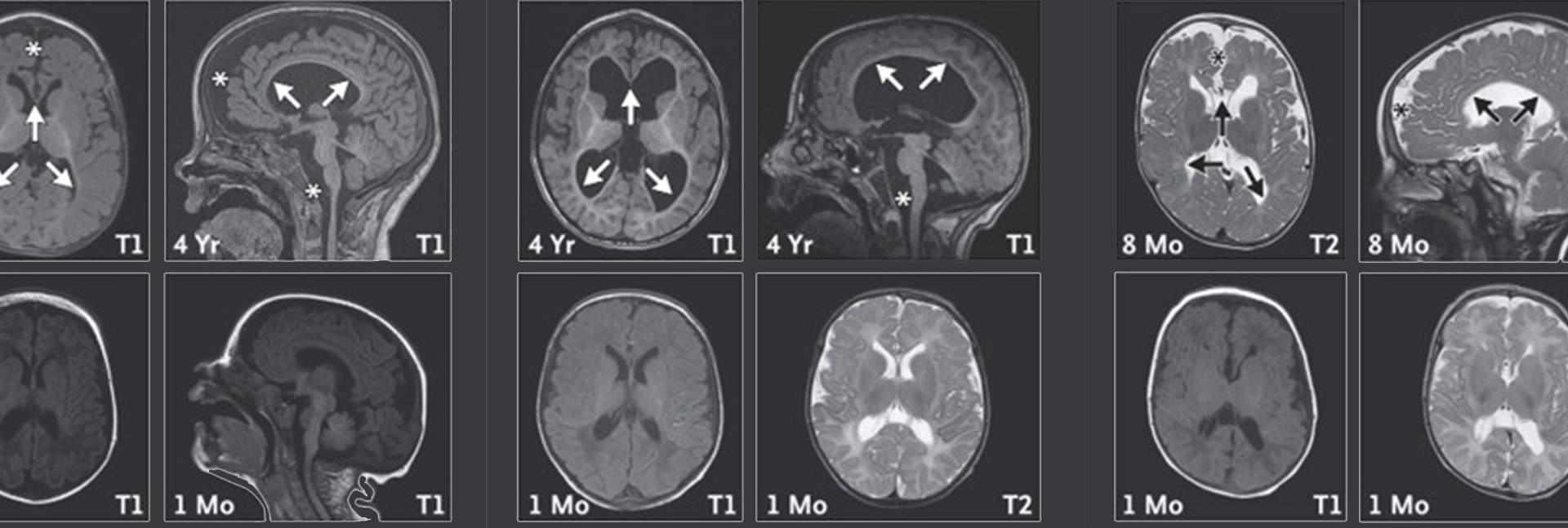 ממצאי דימות תהודה מגנטית (MRI) של המוח בשלושה ילדים עם עותק חסר של צ'ייסר. הסריקות שנעשו בגיל 8 חודשים או 4 שנים (שורה עליונה) מעידות על שינויים מבניים במוח: אזורים קדמיים שהצטמקו, גזע מוח קטן יחסית (מסומן בכוכביות), והתפתחות לא תקינה של מעטפת העצבים (מיאלין) באזורים עמוקים במוח (מסומנת בחיצים). שינויים אלה כמעט שלא נראו בסריקות מגיל חודש (שורה תחתונה)
