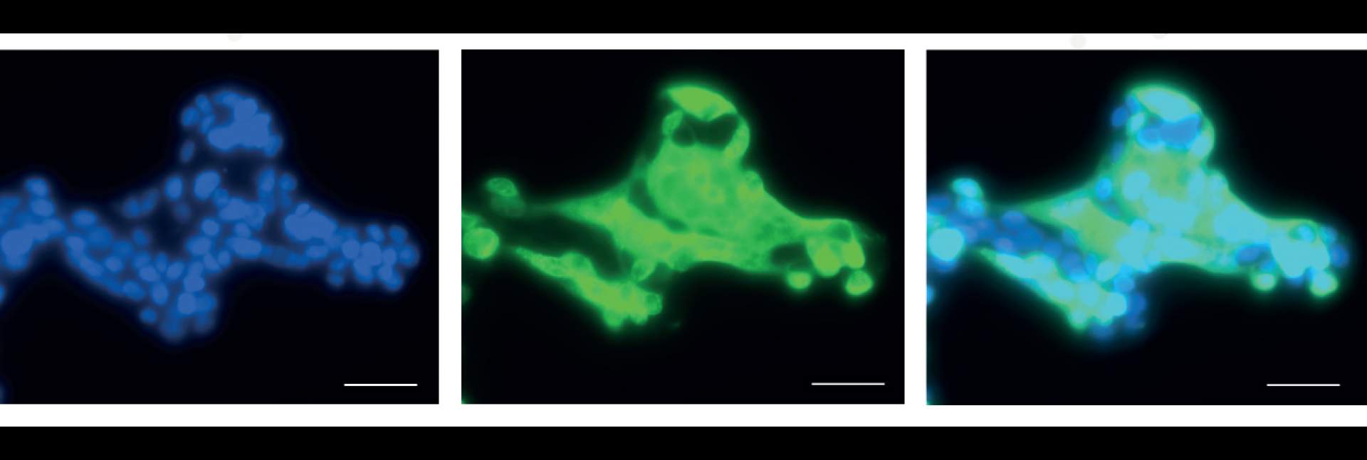 צילום מיקרוסקופי של תאי ריאה אנושיים בתרבית שהודבקו בנגיף הקורונה. מסומנים בכחול (משמאל) - גרעיני התאים, בירוק (במרכז) – הנגיף, בטורקיז (מימין) – התאים שהודבקו בנגיף