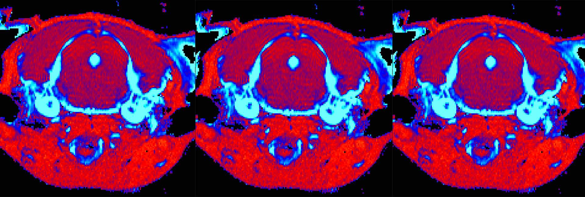 סריקת MRI מוח בעכבר עם מחלת גושה סוג 3 שקיבל טיפול גנטי (מימין) ובעכבר חולה שלא טופל (משמאל). הסריקה חושפת הפחתה משמעותית ברמת הדלקתיות ברקמה (מסומנת בתכלת) בעכבר שטופל 