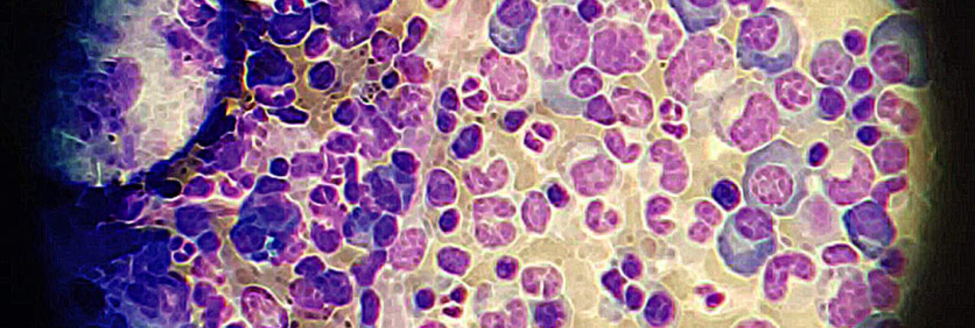 תאים עמידים לתרופות של מיאלומה נפוצה (סגול-כחול) תחת מיקרוסקופ