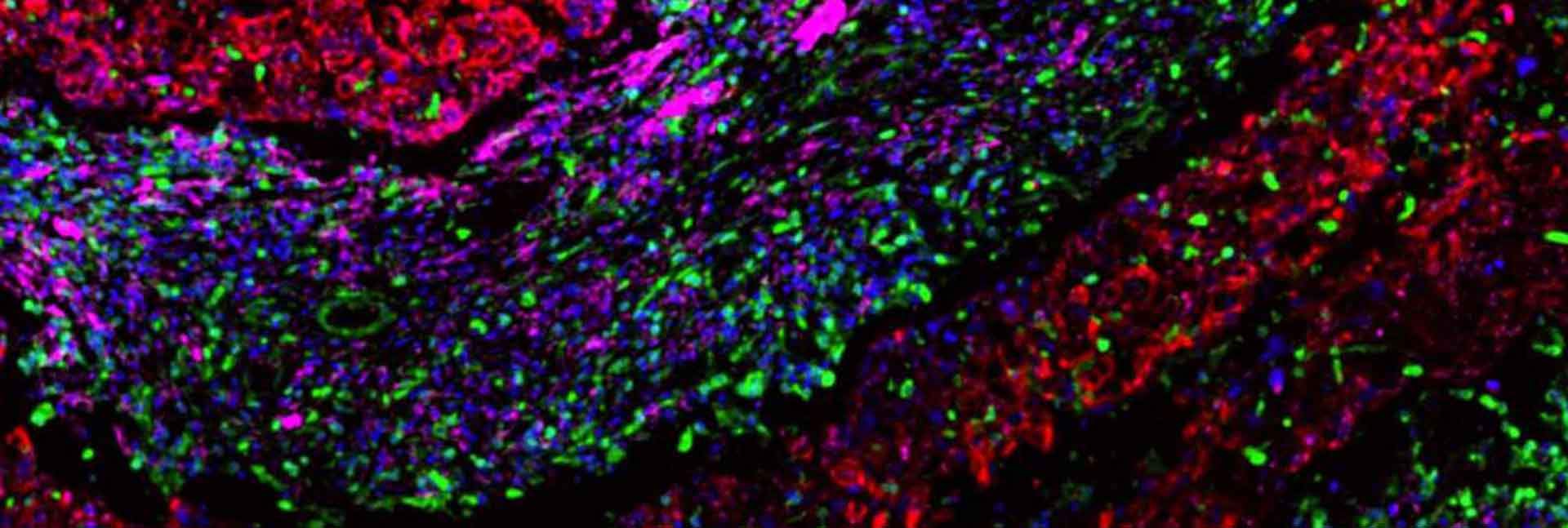רקמת סרטן שד מהסוג טריפל-נגטיב שעברה צביעה כדי לחשוף את התאים הסרטניים (אדום) ואת שני סוגי הפיברובלסטים: pCAFs (ורוד) ו- sCAFs(ירוק). גרעיני כל התאים צבועים בכחול