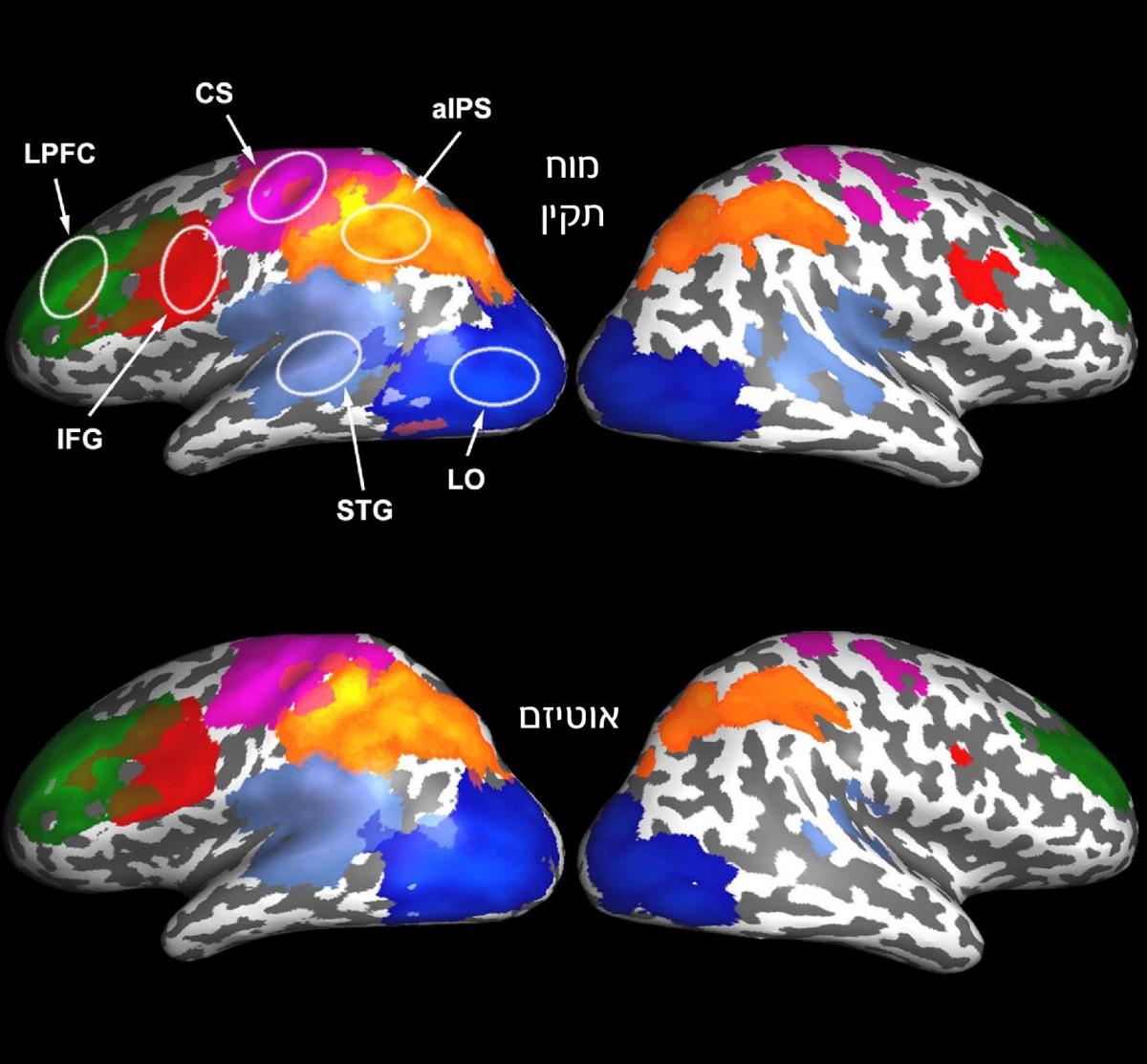 בפעוטות בעלי התפתחות מוח תקינה (למעלה) נראתה רמה גבוהה של פעילות מוחית מסונכרנת, ואילו בפעוטות הסובלים מאוטיזם נראתה פעילות מסונכרנת חלשה באזורי מוח הקשורים בשפה ובתקשורת (באדום ובכחול)